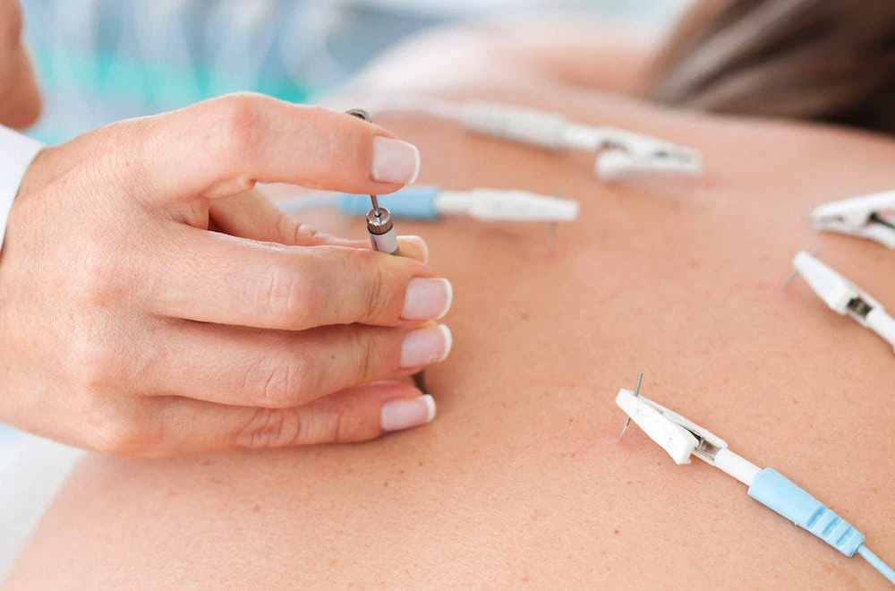 electroacupuncture for pain
