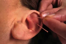 ear acupuncture earlsfield